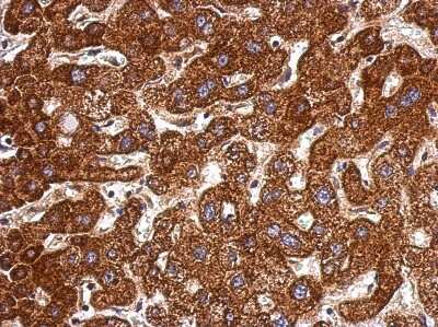 Immunohistochemistry-Paraffin: LSS Antibody [NBP2-17184] - Immunohistochemical analysis of paraffin-embedded Hepatoma, using antibody at 1:500 dilution.