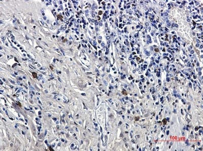 Immunohistochemistry-Paraffin: LTK Antibody (S02-8A4) [NBP3-19886] - Immunohistochemical of LTK in Human lung cancer tissue using LTK antibody at dilution 1/50