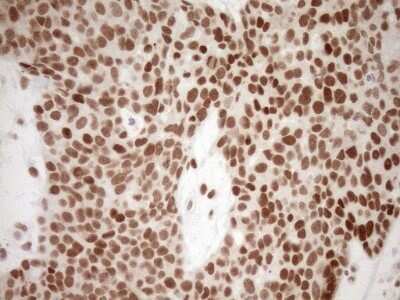 Immunohistochemistry: LXR alpha/NR1H3 Antibody (OTI1A5) - Azide and BSA Free [NBP2-72550] - Analysis of Adenocarcinoma of Human endometrium tissue. (Heat-induced epitope retrieval by 1mM EDTA in 10mM Tris buffer (pH8.5) at 120C for 3 min)(1:150)