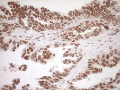 Immunohistochemistry: LXR alpha/NR1H3 Antibody (OTI1A5) - Azide and BSA Free [NBP2-72550] - Analysis of Adenocarcinoma of Human ovary tissue. (Heat-induced epitope retrieval by 1mM EDTA in 10mM Tris buffer (pH8.5) at 120C for 3 min)(1:150)