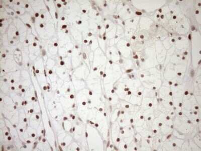 Immunohistochemistry: LXR alpha/NR1H3 Antibody (OTI1A5) - Azide and BSA Free [NBP2-72550] - Analysis of Carcinoma of Human kidney tissue. (Heat-induced epitope retrieval by 1mM EDTA in 10mM Tris buffer (pH8.5) at 120C for 3 min)(1:150)