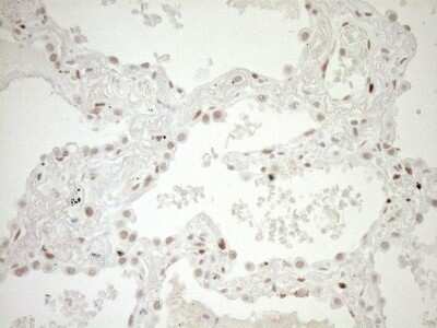 Immunohistochemistry: LXR alpha/NR1H3 Antibody (OTI1A5) - Azide and BSA Free [NBP2-72550] - Analysis of Carcinoma of Human lung tissue.(Heat-induced epitope retrieval by 1mM EDTA in 10mM Tris buffer (pH8.5) at 120C for 3 min)(1:150)