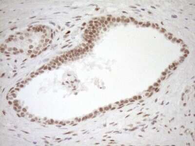 Immunohistochemistry: LXR alpha/NR1H3 Antibody (OTI1A5) - Azide and BSA Free [NBP2-72550] - Analysis of Carcinoma of Human prostate tissue. (Heat-induced epitope retrieval by 1mM EDTA in 10mM Tris buffer (pH8.5) at 120C for 3 min)(1:150)