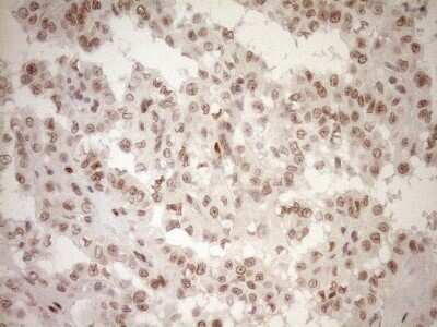 Immunohistochemistry: LXR alpha/NR1H3 Antibody (OTI1A5) - Azide and BSA Free [NBP2-72550] - Analysis of Carcinoma of Human thyroid tissue. (Heat-induced epitope retrieval by 1mM EDTA in 10mM Tris buffer (pH8.5) at 120C for 3 min)(1:150)