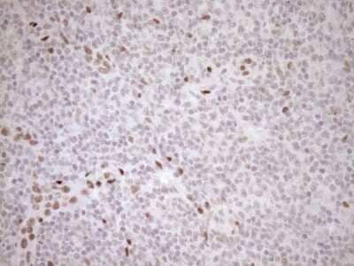 Immunohistochemistry: LXR alpha/NR1H3 Antibody (OTI1A5) - Azide and BSA Free [NBP2-72550] - Analysis of Human lymphoma tissue.(Heat-induced epitope retrieval by 1mM EDTA in 10mM Tris buffer (pH8.5) at 120C for 3 min)