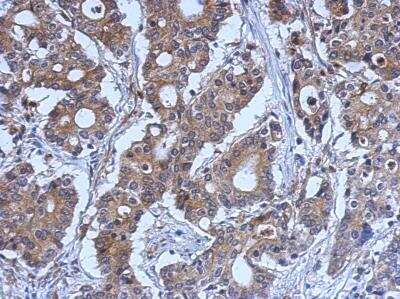 Immunohistochemistry-Paraffin: LYK5 Antibody [NBP2-17187] - Immunohistochemical analysis of paraffin-embedded Gastric ca, using antibody at 1:500 dilution.