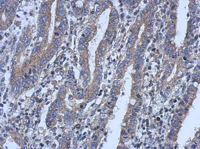 Immunohistochemistry-Paraffin: LYPLA3 Antibody [NBP2-17192] - Immunohistochemical analysis of paraffin-embedded Colon ca, using antibody at 1:500 dilution.