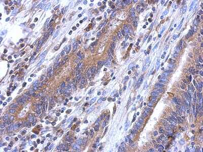 Immunohistochemistry-Paraffin: LYPLA3 Antibody [NBP2-17193] - Human colon carcinoma, using LYPLA3 antibody at 1:500 dilution.  Antigen Retrieval: Trilogy™ (EDTA based, pH 8.0) buffer, 15min. 