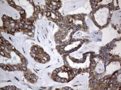 Immunohistochemistry: LYRIC Antibody (1B6) [NBP2-46026] - Analysis of Carcinoma of Human liver tissue.(Heat-induced epitope retrieval by 1 mM EDTA in 10mM Tris, pH8.5, 120C for 3min)