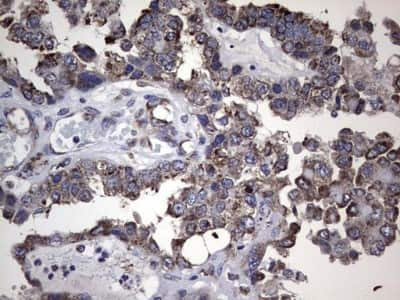 Immunohistochemistry: LYRIC Antibody (1B6) [NBP2-46026] - Analysis of Adenocarcinoma of Human ovary tissue. (Heat-induced epitope retrieval by 1 mM EDTA in 10mM Tris, pH8.5, 120C for 3min)