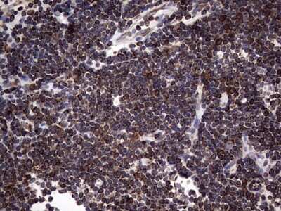 Immunohistochemistry: LYRIC Antibody (1B6) [NBP2-46026] - Analysis of Human lymphoma tissue. (Heat-induced epitope retrieval by 1 mM EDTA in 10mM Tris, pH8.5, 120C for 3min)