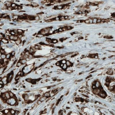 Immunohistochemistry-Paraffin: LYRIC Antibody (CL0397) [NBP2-52929] - Staining of human breast cancer shows strong cytoplasmic immunoreactivity in cancer cells.