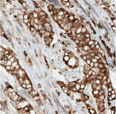 Immunohistochemistry-Paraffin: LYRIC Antibody (CL0401) [NBP2-30458] - Staining of human breast cancer (ductal carcinoma) shows strong cytoplasmic positivity in cancer cells.