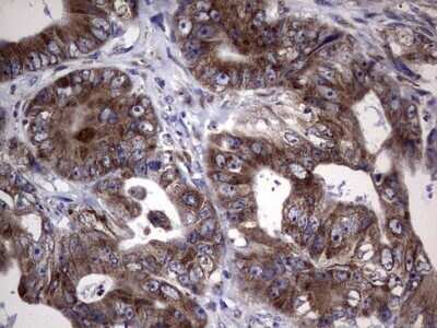 Immunohistochemistry: LYRIC Antibody (OTI1B6) - Azide and BSA Free [NBP2-72552] - Analysis of Adenocarcinoma of Human colon tissue. (Heat-induced epitope retrieval by 1 mM EDTA in 10mM Tris, pH8.5, 120C for 3min)