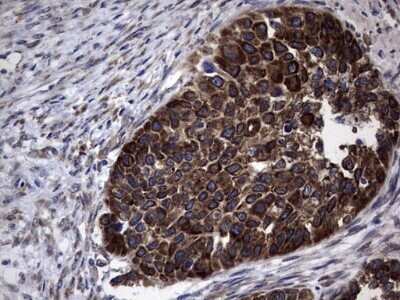 Immunohistochemistry: LYRIC Antibody (OTI1B6) - Azide and BSA Free [NBP2-72552] - Analysis of Carcinoma of Human kidney tissue. (Heat-induced epitope retrieval by 1 mM EDTA in 10mM Tris, pH8.5, 120C for 3min)