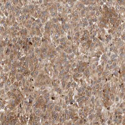 Immunohistochemistry-Paraffin: LZTS1 Antibody [NBP1-83907] - Staining of human malignant melanoma shows moderate cytoplasmic positivity in tumor cells.