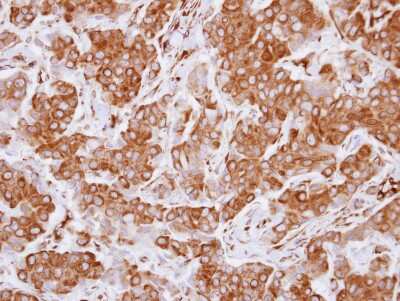 Immunohistochemistry-Paraffin: LZTS1 Antibody [NBP2-17195] - Human breast cancer, using FEZ1 antibody at 1:250 dilution.  Antigen Retrieval: Trilogy™ (EDTA based, pH 8.0) buffer, 15min.