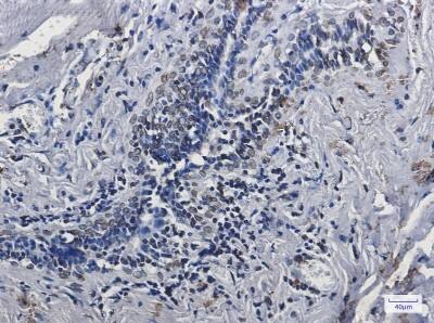 Immunohistochemistry-Paraffin: Lamin A + C Antibody (S06-7H5) [NBP3-19963] - Immunohistochemistry of Lamin A + C in paraffin-embedded Human breast cancer tissue using NBP3-19963 at dilution 1/5