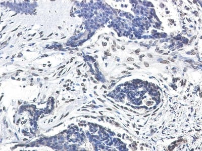 Immunohistochemistry-Paraffin: Lamin A + C Antibody (S07-1I5) [NBP3-19988] - Immunohistochemistry of Lamin A + C in paraffin-embedded Human breast cancer tissue using NBP3-19988 at dilution 1/50