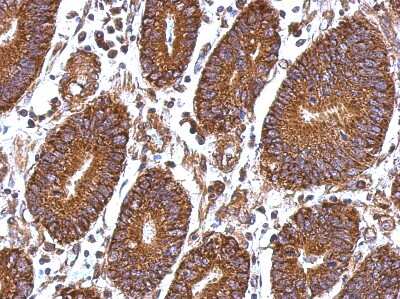 Immunohistochemistry-Paraffin: Laminin beta 1 Antibody [NBP1-32043] -  Human colon carcinoma, using Laminin beta 1antibody at 1:500 dilution.  Antigen Retrieval: Trilogy™ (EDTA based, pH 8.0) buffer, 15min. 