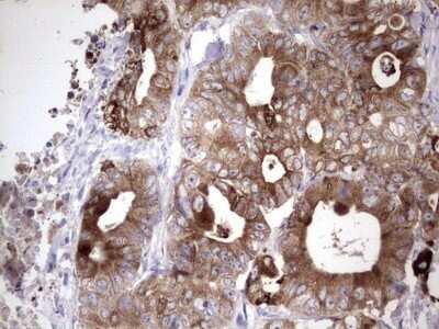 Immunohistochemistry: Laminin beta 3 Antibody (OTI3A2) - Azide and BSA Free [NBP2-71115] - Analysis of Adenocarcinoma of Human colon tissue. (Heat-induced epitope retrieval by 1 mM EDTA in 10mM Tris, pH8.5, 120C for 3min)