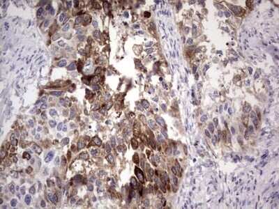 Immunohistochemistry: Laminin beta 3 Antibody (OTI3A2) - Azide and BSA Free [NBP2-71115] - Analysis of Carcinoma of Human kidney tissue. (Heat-induced epitope retrieval by 1 mM EDTA in 10mM Tris, pH8.5, 120C for 3min)