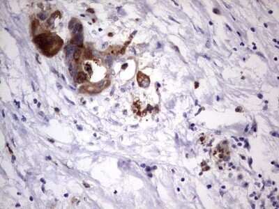 Immunohistochemistry: Laminin beta 3 Antibody (OTI3A2) - Azide and BSA Free [NBP2-71115] - Analysis of Carcinoma of Human pancreas tissue. (Heat-induced epitope retrieval by 1 mM EDTA in 10mM Tris, pH8.5, 120C for 3min)