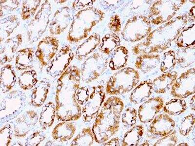 Immunohistochemistry-Paraffin: Laminin gamma 1 Antibody (A5) - IHC-Prediluted [NBP2-48357] - Formalin-fixed, paraffin-embedded human Renal Cell Carcinoma stained with Laminin Rat Monoclonal Antibody (A5).