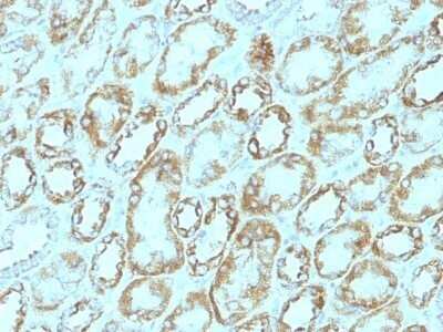 Immunohistochemistry-Paraffin: Laminin gamma 1 Antibody (A5) - IHC-Prediluted [NBP2-48357] - Human Renal Cell Carcinoma stained with Laminin Monoclonal Antibody (A5).