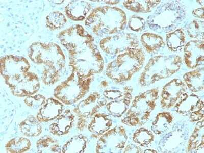 Immunohistochemistry-Paraffin: Laminin gamma 1 Antibody (SPM193) [NBP2-44752] - Human Renal Cell Carcinoma stained with Laminin Monoclonal Antibody (SPM193).