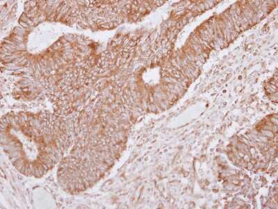 Immunohistochemistry-Paraffin: Lano Antibody [NBP2-19332] - Immunohistochemical analysis of paraffin-embedded Breast ca, using antibody at 1:250 dilution.
