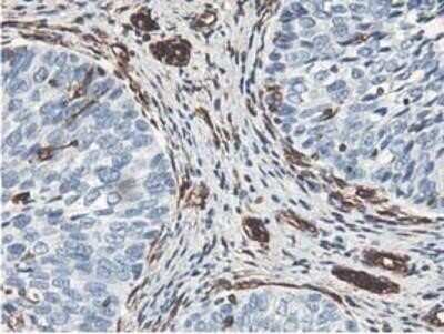 Immunohistochemistry: Latexin Antibody (OTI1E10) - Azide and BSA Free [NBP2-72069] - Staining of paraffin-embedded Carcinoma of Human bladder tissue using anti-LXN mouse monoclonal antibody.