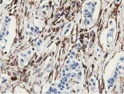 Immunohistochemistry: Latexin Antibody (OTI1E10) - Azide and BSA Free [NBP2-72069] - Staining of paraffin-embedded Carcinoma of Human lung tissue using anti-LXN mouse monoclonal antibody.