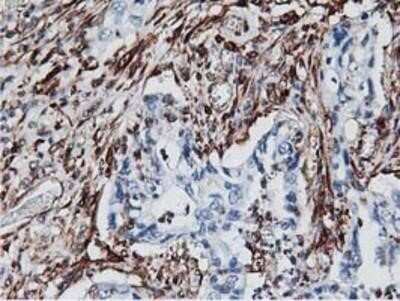 Immunohistochemistry: Latexin Antibody (OTI1E10) - Azide and BSA Free [NBP2-72069] - Staining of paraffin-embedded Carcinoma of Human pancreas tissue using anti-LXN mouse monoclonal antibody.