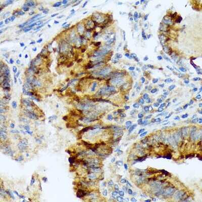 Immunohistochemistry-Paraffin: Lefty1/2 Antibody (2Y10P2) [NBP3-16118] - Immunohistochemistry of paraffin-embedded human colon carcinoma using Lefty1/2 Rabbit mAb (NBP3-16118) at dilution of 1:100 (40x lens).Perform microwave antigen retrieval with 10 mM Tris/EDTA buffer pH 9.0 before commencing with IHC staining protocol.