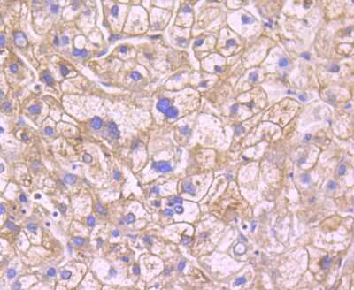 Immunohistochemistry-Paraffin: Leptin R Antibody (JA73-01) [NBP2-66931] - Analysis of paraffin-embedded human liver cancer tissue using anti-Leptin Receptor antibody. Counter stained with hematoxylin.