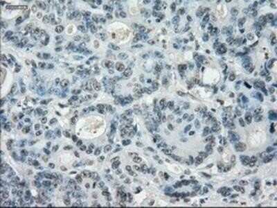 Immunohistochemistry: Leukotriene A4 Hydrolase/LTA4H Antibody (OTI1E9) - Azide and BSA Free [NBP2-71189] - Staining of paraffin-embedded Adenocarcinoma of colon tissue using anti-Leukotriene A4 hydrolase mouse monoclonal antibody.