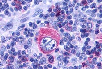 Immunohistochemistry-Paraffin: Leukotriene B4 Receptor 2 Antibody [NLS2099] - Human Lymph Node, Hodgkins Lymphoma.  Immunohistochemistry of formalin-fixed, paraffin-embedded tissue after heat-induced antigen retrieval.