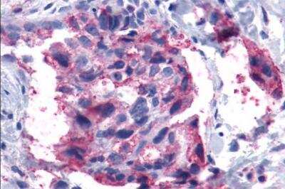 Immunohistochemistry-Paraffin: Leukotriene B4 Receptor 2 Antibody [NLS2099] - Breast, carcinoma