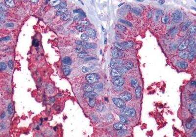 Immunohistochemistry-Paraffin: Leukotriene B4 Receptor 2 Antibody [NLS2099] - Colon, carcinoma