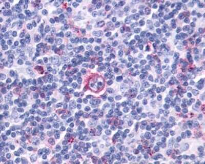 Immunohistochemistry-Paraffin: Leukotriene B4 Receptor 2 Antibody [NLS2102] - Analysis of anti-LTB4R2 / BLT2 antibody with human lymph node, Hodgkins lymphoma.