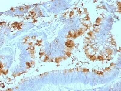 Immunohistochemistry-Paraffin: Lewis A Blood Group Antigen Antibody (SPM522) - IHC-Prediluted [NBP2-48080] - Human Colon Carcinoma stained with Lewis A Monoclonal Antibody (SPM522).