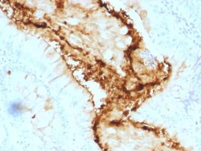 Immunohistochemistry-Paraffin: Lewis Y Antibody (A70-A/A9) [NBP2-54561] - Formalin-fixed, paraffin-embedded human Colon Carcinoma stained with Lewis Y Monoclonal Antibody (A70-A/A9).