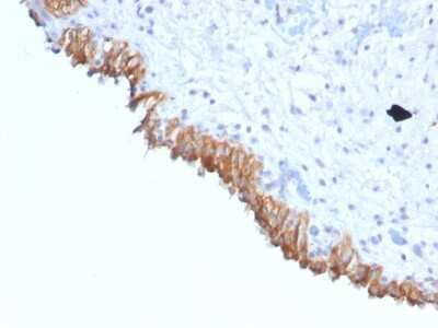 Immunohistochemistry-Paraffin: Lewis Y Antibody (A70-C/C8) [NBP2-54350] - Formalin-fixed, paraffin-embedded human Colon Carcinoma stained with Lewis Y Monoclonal Antibody (A70-C/C8).