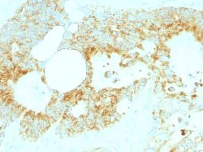 Immunohistochemistry-Paraffin: Lewis Y Antibody (A70-C/C8) [NBP2-54350] - Formalin-fixed, paraffin-embedded human Colon Carcinoma stained with Lewis Y Monoclonal Antibody (A70-C/C8).