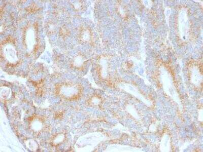 Immunohistochemistry-Paraffin: Lewis Y Antibody (A70-C/C8) [NBP2-54350] - Formalin-fixed, paraffin-embedded human  Colon Carcinoma stained with  Lewis Y Monoclonal Antibody