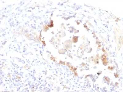 Immunohistochemistry-Paraffin: Lewis Y Antibody (LWY/1463) [NBP2-54560] - Formalin-fixed, paraffin-embedded human Lung Carcinoma stained with Lewis Y Monoclonal Antibody (LWY/1463).