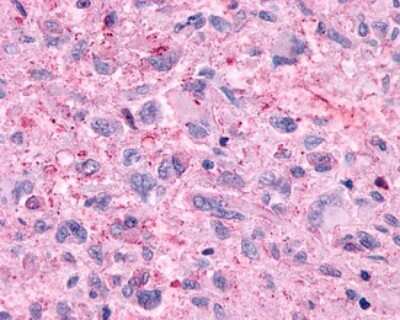 Immunohistochemistry-Paraffin: Lgr4/GPR48 Antibody [NLS1631] - Analysis of anti-GPR48 / LGR4 antibody with human brain, glioblastoma.