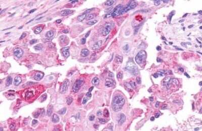 Immunohistochemistry-Paraffin: Lgr4/GPR48 Antibody [NLS1631] - Anti-GPR48 / LGR4 antibody IHC of human Pancreas, Carcinoma. Immunohistochemistry of formalin-fixed, paraffin-embedded tissue after heat-induced antigen retrieval.