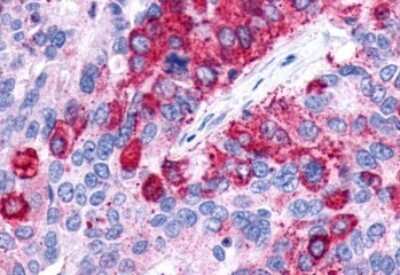 Immunohistochemistry-Paraffin: Lgr4/GPR48 Antibody [NLS1631] - Anti-GPR48 / LGR4 antibody IHC of human Lung, Adenocarcinoma. Immunohistochemistry of formalin-fixed, paraffin-embedded tissue after heat-induced antigen retrieval.